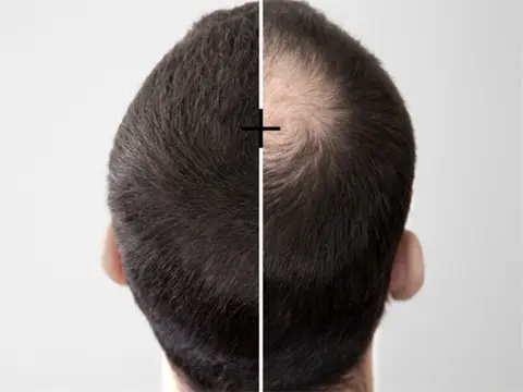 Dun haar? Kale plekken; wij hebben een oplossing