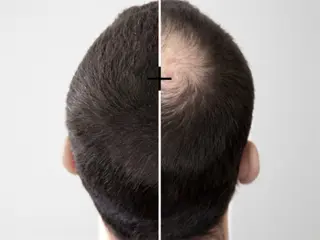 Dun haar? Kale plekken; wij hebben een oplossing