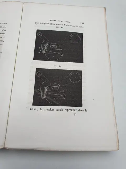 Dr. Serre - Essai sur les Phosphènes ou Anneaux Lumineux de la Rétine - 1853