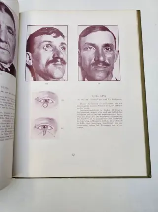 Professor Dr. Josef Imre - Lidplastik und plastische Operationen anderer Weichteile des Gesichts - 1928