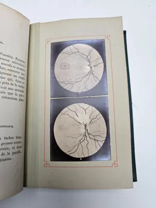 L. De Wecker et J. Masselon - Ophthalmoscopie Clinique - 1881