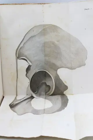 W. Lawrence, F.R.S - Traité Des Hernies - 1818